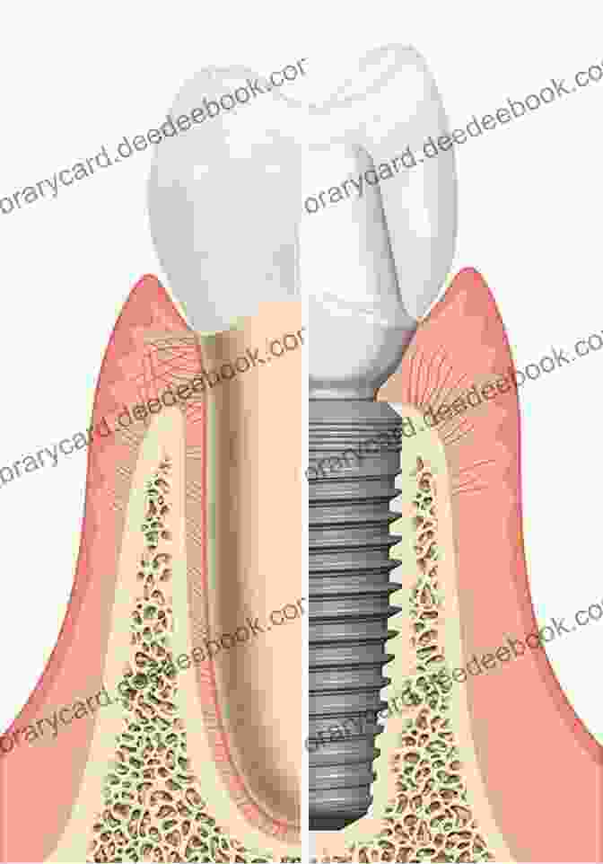 Image Depicting The Process Of Immediate Dental Implant Loading Atlas Of Immediate Dental Implant Loading