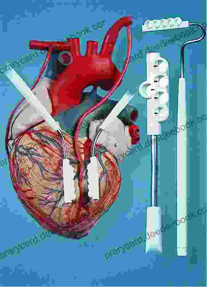 Off Pump Cardiac Surgery Dawn And Evolution Of Cardiac Procedures: Research Avenues In Cardiac Surgery And Interventional Cardiology