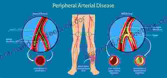 Peripheral Artery Disease Treatment Dawn And Evolution Of Cardiac Procedures: Research Avenues In Cardiac Surgery And Interventional Cardiology