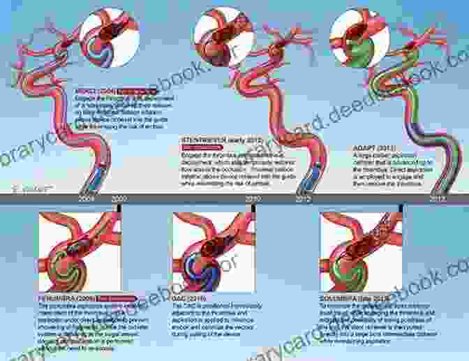 Thrombectomy Dawn And Evolution Of Cardiac Procedures: Research Avenues In Cardiac Surgery And Interventional Cardiology