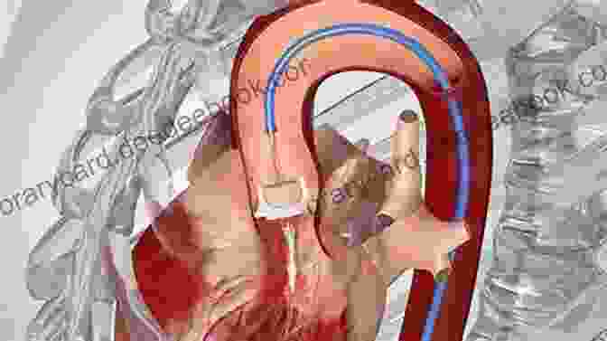 Transcatheter Aortic Valve Replacement Dawn And Evolution Of Cardiac Procedures: Research Avenues In Cardiac Surgery And Interventional Cardiology