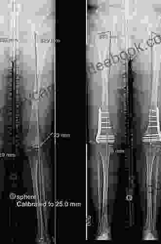 Limb Lengthening And Reconstruction Surgery